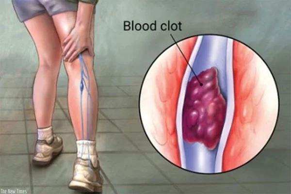 DVT Ameliyatı  Fiyatı Nedir